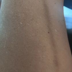 North Texas Vein and Vascular - Brown deep bruising over a year old from vein procedure done at North Texas Vein on Flower Mound.