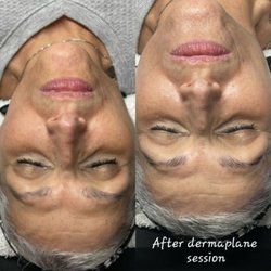 Dermaplane facial