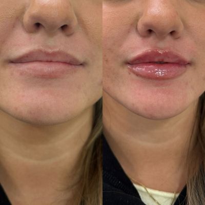 Lip Filler - Subtle lip enhancement using hyaluronic acid filler to restore balance and definition while maintaining a natural shape. Each treatment is customized to enhance the client’s unique lip structure and proportions. Photos show immediate results post-treatment. Lip Filler - Subtle lip enhancement using hyaluronic acid filler to restore balance and definition while maintaining a natural shape. Each treatment is customized to enhance the client’s unique lip structure and proportions. Photos show immediate results post-treatment.
