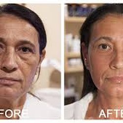 SkinLab - Sculplla Poly L-Lactic Acid Mask is a safe, non-injection treatment that stimulates collagen, resulting in firmer smoother skin.