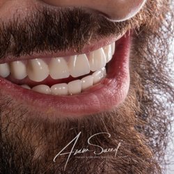Ace Dental Center - Here is an all on 4 upper and lower with acrylic teeth with a titanium bar.