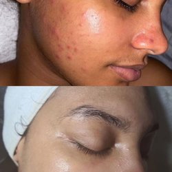 Mek Beauty Esthetic - Acné facial