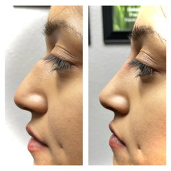 SkinRenew Laser Medical Center - Subtle Nose Refinement by Dr. Grace Kwon