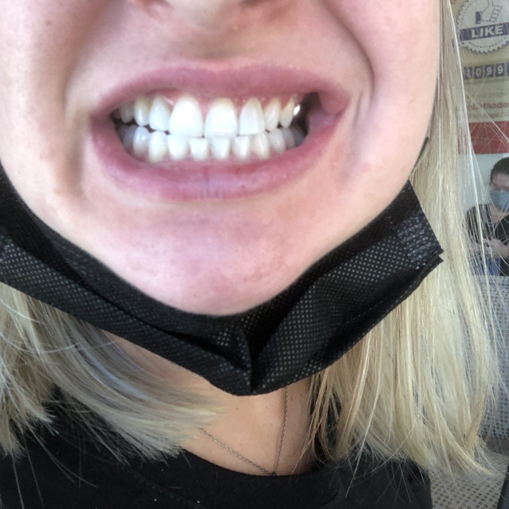Molen Orthodontics - Before: It looks like I have three front teeth. Both of her attempts didn't match my other k-9 at all. So unhappy with the result. - Orthodontists Near Me - Auburn, Washington Molen Orthodontics - Before: It looks like I have three front teeth. Both of her attempts didn't match my other k-9 at all. So unhappy with the result. - Orthodontists Near Me - Auburn, Washington