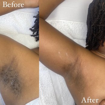 Hadley Rose Esthetics - Under arm sugaring before and afer. - Skin Care Near Me - Long Beach, California