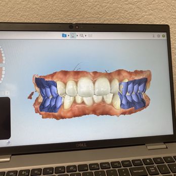 Triple S Dental - Invisalign scan - Cosmetic Dentists Near Me - Covina, California Triple S Dental - Invisalign scan - Cosmetic Dentists Near Me - Covina, California
