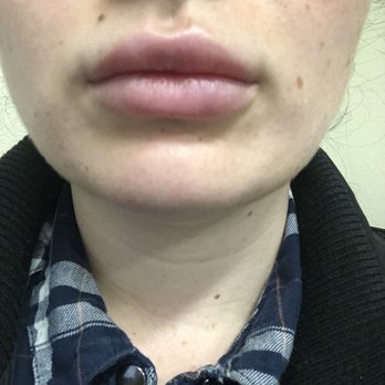 Artemedica - 1 week post injection (juvederm) - Medical Spas Near Me - Santa Rosa, California Artemedica - 1 week post injection (juvederm) - Medical Spas Near Me - Santa Rosa, California