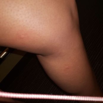 Courtyard by Marriott Ithaca Airport/University - Bites on my leg - Hotels Near Me - Ithaca, New York