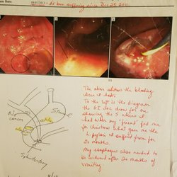 CommonSpirit Longmont United Hospital - These are the ulcers found ONE MONTH LATER--LUH LIED and said they scoped my stomach. I suffered another month before these were discovered.
