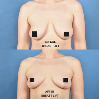 Michael Delong, MD - BEFORE/AFTERS - Cosmetic Surgeons Near Me - Los Angeles, California Michael Delong, MD - BEFORE/AFTERS - Cosmetic Surgeons Near Me - Los Angeles, California
