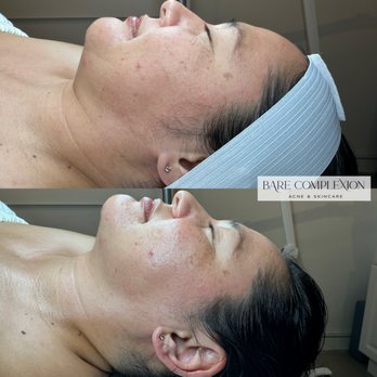 Bare Complexion - Lymphatic Drainage to release toxins, create oxygen and depuff the face. Bare Complexion Acne & Skincare - Skin Care Near Me - Ventura, California