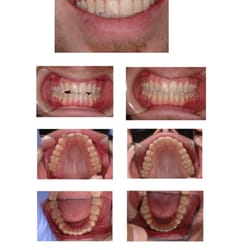 Zonies-Holgado Dental Associates - Note improved smile and even spacing of teeth