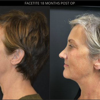 SkinMD - 18 months POST OP FACETITE - Laser Hair Removal Near Me - Boston, Massachusetts SkinMD - 18 months POST OP FACETITE - Laser Hair Removal Near Me - Boston, Massachusetts