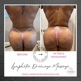 Luxury Recovery Spa - This is my BEFORE and AFTER following 6 sessions. - IV Hydration Near Me - Escondido, California Luxury Recovery Spa - This is my BEFORE and AFTER following 6 sessions. - IV Hydration Near Me - Escondido, California