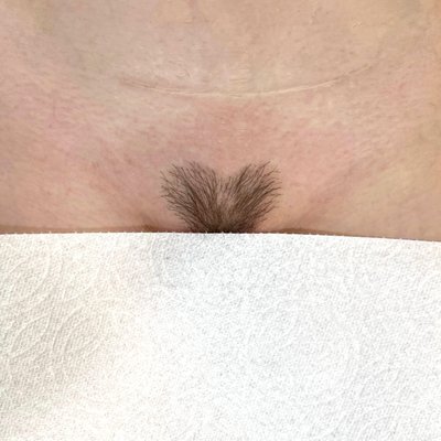 Sugaring - Similar to waxing, sugaring removes body hair by using a natural paste made of sugar, lemon, and water. Brazilian includes full mons pubis, labias, butt strip, and 3 inches outside of the bikini line. Hair must be 1/4” or the length of a grain of rice. That’s approximately 2-4 weeks of hair growth. Sugaring - Similar to waxing, sugaring removes body hair by using a natural paste made of sugar, lemon, and water. Brazilian includes full mons pubis, labias, butt strip, and 3 inches outside of the bikini line. Hair must be 1/4” or the length of a grain of rice. That’s approximately 2-4 weeks of hair growth.