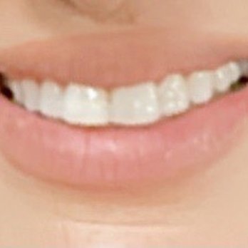 Summy Abbassi, DDS - After - Cosmetic Dentists Near Me - Tarzana, California