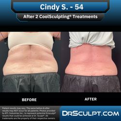 Dr. Sculpt CoolSculpting & EmSculpt Center - After 2 CoolSculpting treatments on abdomen/flanks