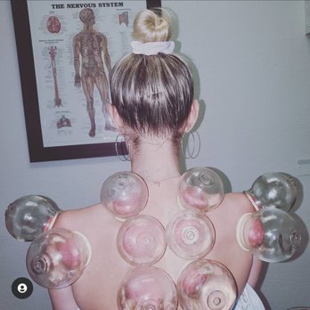 Rick Peterson, LAc, MSTOM - Cupping therapy is useful for pain management, reduce stress and anxiety, and great for increased lung function and asthma. - Acupuncture Near Me - Carlsbad, California Rick Peterson, LAc, MSTOM - Cupping therapy is useful for pain management, reduce stress and anxiety, and great for increased lung function and asthma. - Acupuncture Near Me - Carlsbad, California
