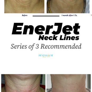 Renewlogie Med Spa - Enerjet is a needless regenerative procedure that can be used to treat neck lines. Series of 3 recommended, done one month apart. - Medical Spas Near Me - La Canada Flintridge, California Renewlogie Med Spa - Enerjet is a needless regenerative procedure that can be used to treat neck lines. Series of 3 recommended, done one month apart. - Medical Spas Near Me - La Canada Flintridge, California