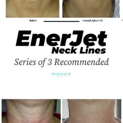 Renewlogie Med Spa - Enerjet is a needless regenerative procedure that can be used to treat neck lines. Series of 3 recommended, done one month apart.