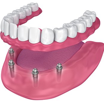 Asha Dental - All-on4 Dental Implants - Cosmetic Dentists Near Me - Leawood, Kansas