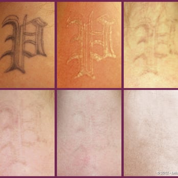 Tattoolos - Tattoo Removal Near Me - Berlin, BE