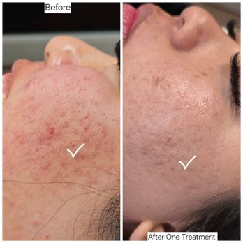 Trangs Touch Artistry - Acne scar treatment by @instaTrang
(714) 702-5274 - Eyelash Service Near Me - Honolulu, Hawaii Trangs Touch Artistry - Acne scar treatment by @instaTrang
(714) 702-5274 - Eyelash Service Near Me - Honolulu, Hawaii
