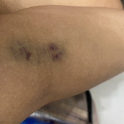 Clinical Pathology Laboratories - Bruised arm