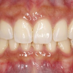 Chris Chen Orthodontics - The gap is gone!