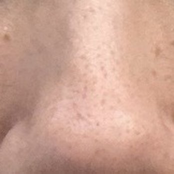 Scar Healing Institute - Lines under my eyes - Dermatologists Near Me - Beverly Hills, California Scar Healing Institute - Lines under my eyes - Dermatologists Near Me - Beverly Hills, California