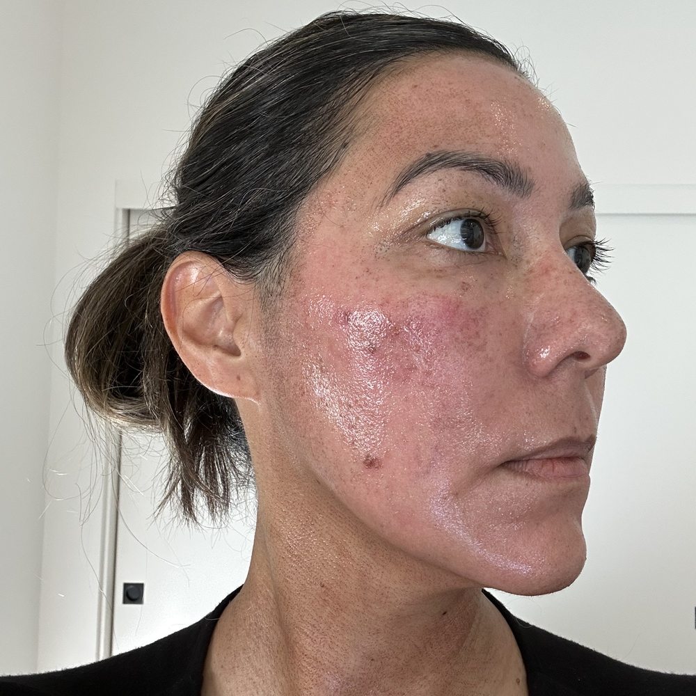 A. David Rahimi, MD, FAAD - Forever Young - Post op day 3 - Dermatologists Near Me - Los Angeles, California A. David Rahimi, MD, FAAD - Forever Young - Post op day 3 - Dermatologists Near Me - Los Angeles, California
