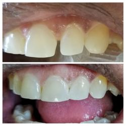 Smiles By Gentle Dental - Closing spaces between teeth by white filling material