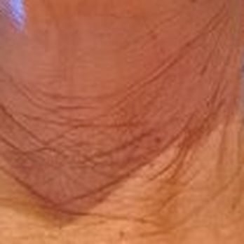 David N. White, M.D - 5 months post face/neck lift. My head is slightly lifted so this is a bit less wrinkled than it is. - Cosmetic Surgeons Near Me - Palo Alto, California David N. White, M.D - 5 months post face/neck lift. My head is slightly lifted so this is a bit less wrinkled than it is. - Cosmetic Surgeons Near Me - Palo Alto, California