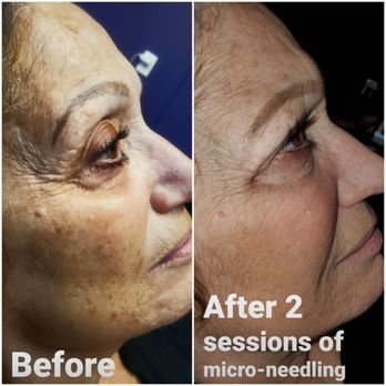 Nikki's Tattoo Studio - Before and after micro needling. Not like clinical micro needling, better tools and lots of experience give outstanding results - Tattoo Near Me - Charlotte, North Carolina Nikki's Tattoo Studio - Before and after micro needling. Not like clinical micro needling, better tools and lots of experience give outstanding results - Tattoo Near Me - Charlotte, North Carolina