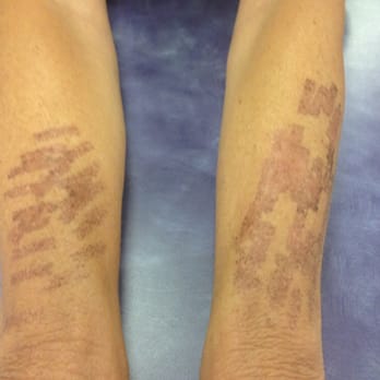 Fun Aesthetics - Burns on both hands - Laser Hair Removal Near Me - Riverside, California Fun Aesthetics - Burns on both hands - Laser Hair Removal Near Me - Riverside, California