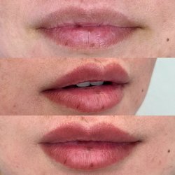 Minnow - Before and after of filler and lip blush (1 session) . Two sessions are required to achieve an even result