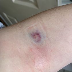 Quest Diagnostics - Blood draw