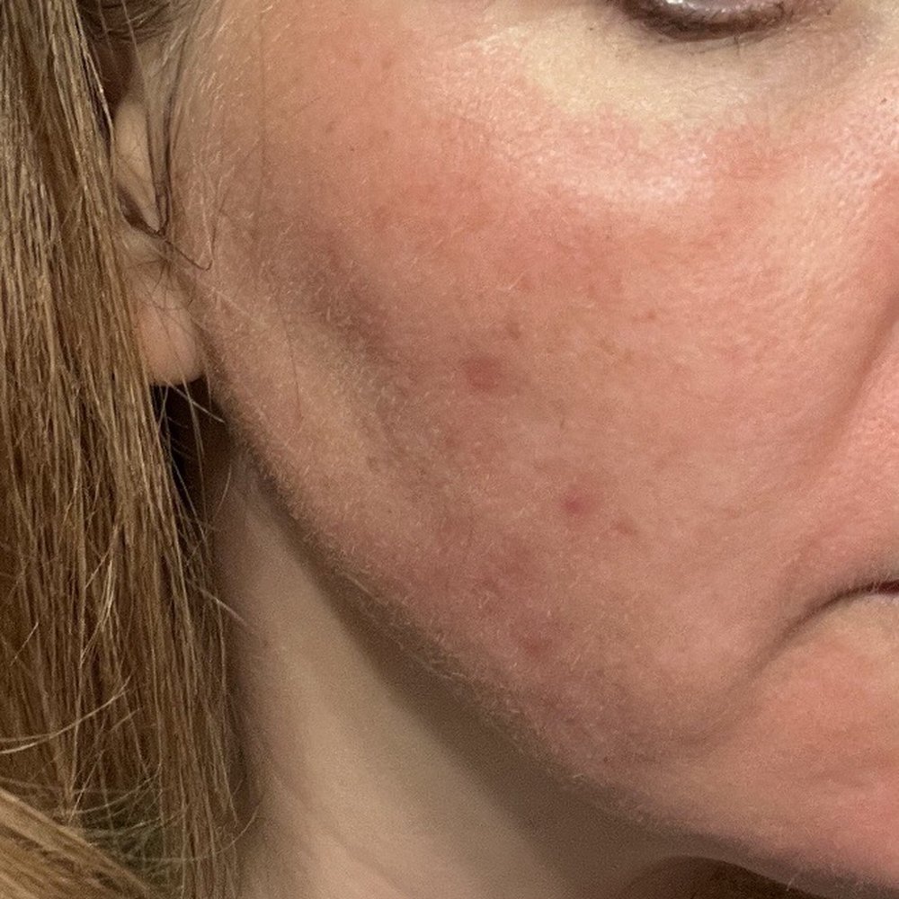 Acne scarring starting to improve after 2 Yag Laser treatments and 2 Tixel treatments