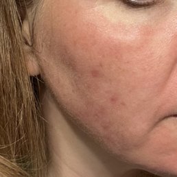Acne scarring starting to improve after 2 Yag Laser treatments and 2 Tixel treatments