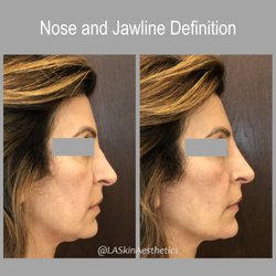 LA SkinAesthetics - Nose and jawline rejuvenation: dermal fillers used to subtly straighten the nose and jawline