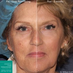 Cosmetic Laser Dermatology - Laser Skin Resurfacing Results Post 5-Months