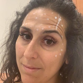 RegenerateMe - Before. - Medical Spas Near Me - Las Vegas, Nevada
