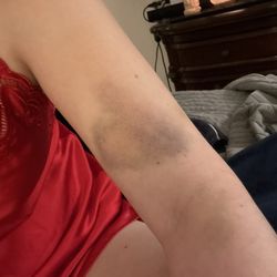 Denver Police Headquarters - Bruises
