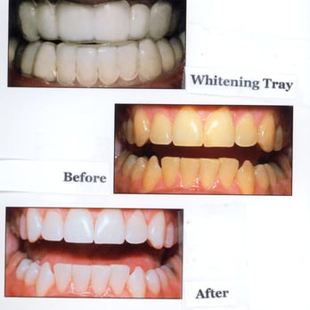 Stewart C Brody, DDS - Whitening Trays - General Dentistry Near Me - Great Neck, New York Stewart C Brody, DDS - Whitening Trays - General Dentistry Near Me - Great Neck, New York