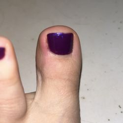 Escape Nails & Day Spa  - Inflamed toenail