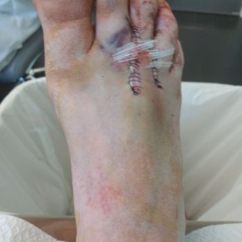 Henry Tseng, DPM - 5 days after nerouma surgery. With sterile strips placed over stiches. And iodine applied to prevent any infection. - Podiatrists Near Me - West Covina, California Henry Tseng, DPM - 5 days after nerouma surgery. With sterile strips placed over stiches. And iodine applied to prevent any infection. - Podiatrists Near Me - West Covina, California
