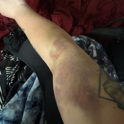 BioLife Plasma Services - The bruise is half my arm!