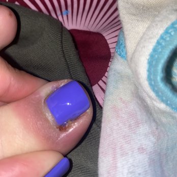Star Nails - Infected nail - Nail Salons Near Me - Fresno, California Star Nails - Infected nail - Nail Salons Near Me - Fresno, California