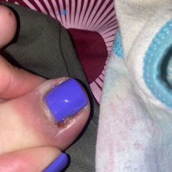 Star Nails - Infected nail