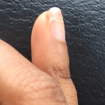 Nail Accents - Side view of overgrown nail by Nail Accents - Nail Salons Near Me - Atlanta, Georgia Nail Accents - Side view of overgrown nail by Nail Accents - Nail Salons Near Me - Atlanta, Georgia